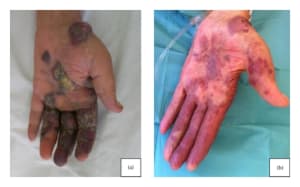 berbagai penyakit kulit, sarkoma kaposi